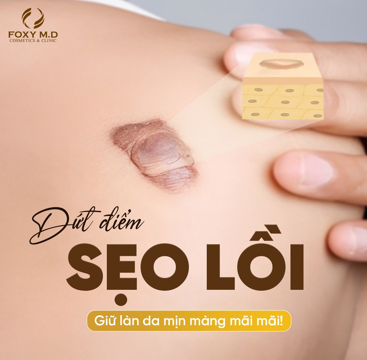 Điều trị sẹo